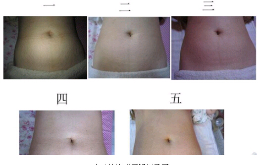 去妊娠纹产品排名_去妊娠纹进口产品
