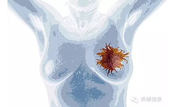 去国外看病:乳腺癌!保乳手术优于乳房切除术?