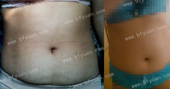 去妊娠纹产品排名_去妊娠纹进口产品