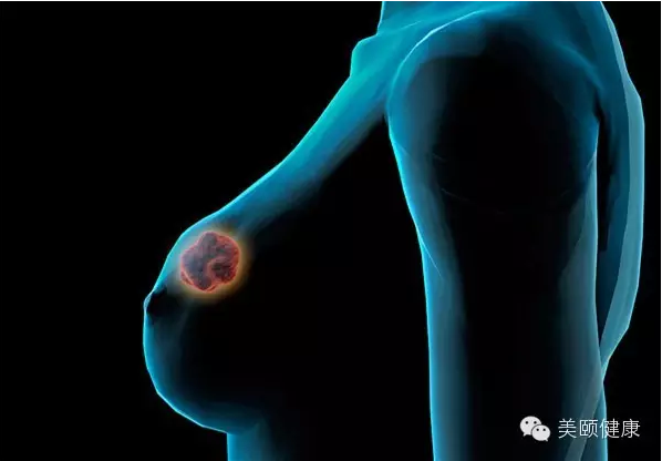去国外看病:乳腺癌!保乳手术优于乳房切除术?